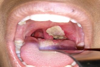 Deadly Diphtheria: What You Need to Know About Nigeria's Disease Outbreak